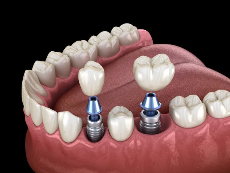 Why Are Dental Implants Considered a Good Option for Tooth Replacement?